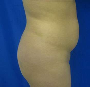 Liposuction Before & After Patient #9487