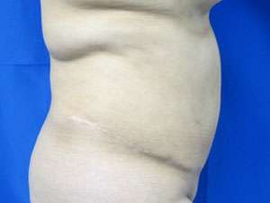 Liposuction Before & After Patient #9490