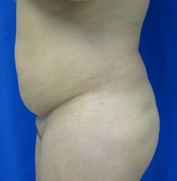 Liposuction Before & After Patient #9493