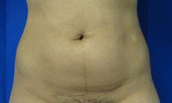 Liposuction Before & After Patient #9496