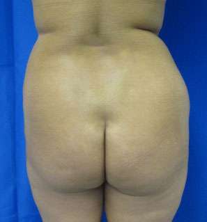 Liposuction Before & After Patient #9499