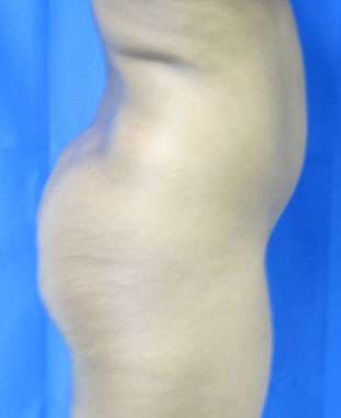 Liposuction Before & After Patient #9502