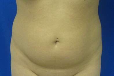 Liposuction Before & After Patient #9505