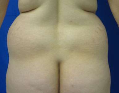 Liposuction Before & After Patient #9511