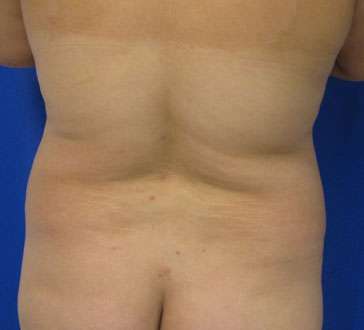 Liposuction Before & After Patient #9514
