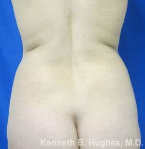 Liposuction Before & After Patient #9519