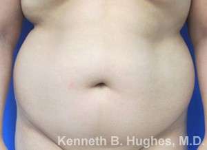 Liposuction Before & After Patient #9522