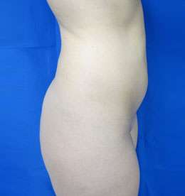 Liposuction Before & After Patient #9525