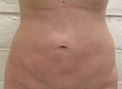 Liposuction Revision Cellulite Reduction Before & After Patient #9531
