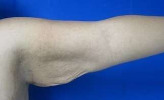 Arm Lift Before & After Patient #5940