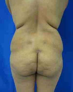 Brazilian Butt Lift Before & After Patient #6814