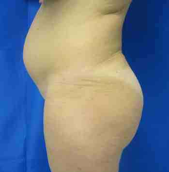 Brazilian Butt Lift Before & After Patient #6819