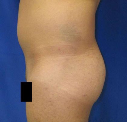 Brazilian Butt Lift Before & After Patient #6835