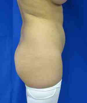 Brazilian Butt Lift Before & After Patient #6849