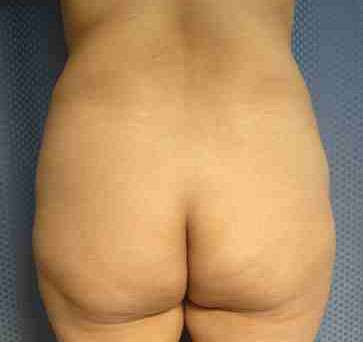 Brazilian Butt Lift Before & After Patient #6868