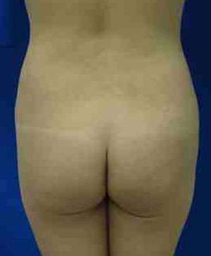 Brazilian Butt Lift Before & After Patient #6873