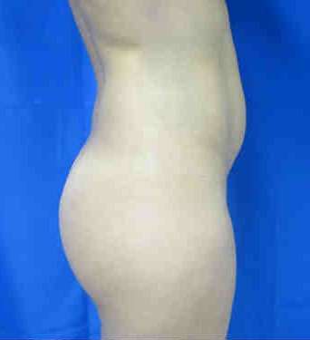 Brazilian Butt Lift Before & After Patient #6878