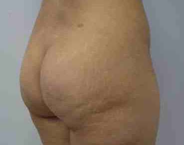 Brazilian Butt Lift Before & After Patient #6903