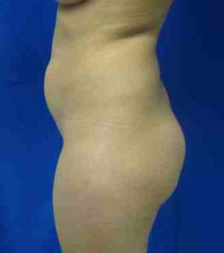 Brazilian Butt Lift Before & After Patient #6914