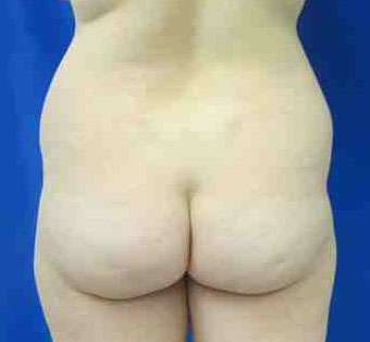 Brazilian Butt Lift Before & After Patient #6919