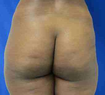 Brazilian Butt Lift Before & After Patient #6930