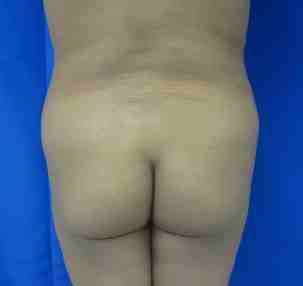 Brazilian Butt Lift Before & After Patient #6935