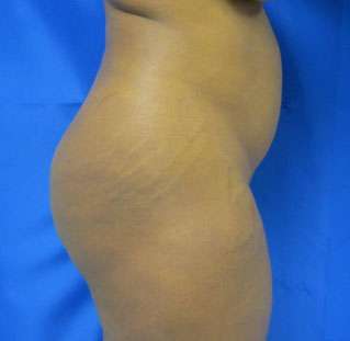Brazilian Butt Lift Before & After Patient #6940