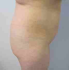 Brazilian Butt Lift Before & After Patient #6945