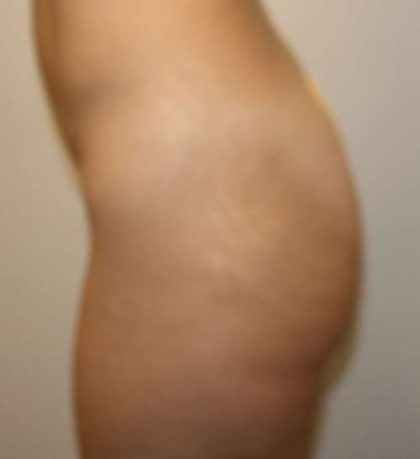 Brazilian Butt Lift for Thinner Patients Before & After Patient #6978
