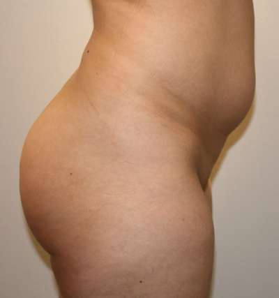 Brazilian Butt Lift Before & After Patient #6987