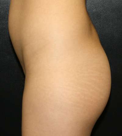 Brazilian Butt Lift Before & After Patient #6995