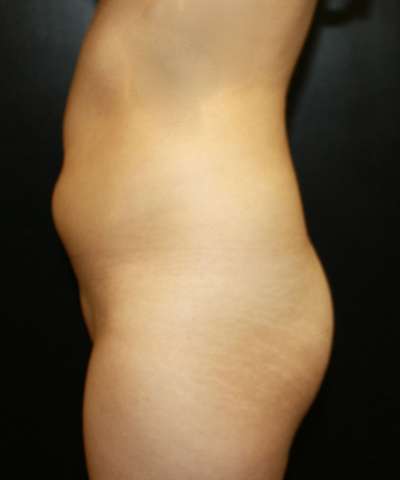 Brazilian Butt Lift for Thinner Patients Before & After Patient #7021