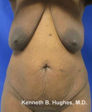 Breast Augmentation and Lift Before & After Patient #7041