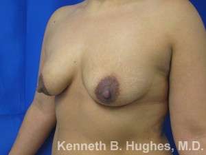 Breast Augmentation and Lift Before & After Patient #7057
