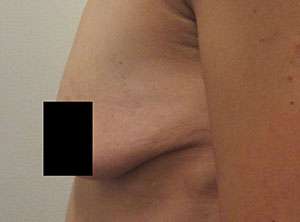 Breast Augmentation and Lift Before & After Patient #7177