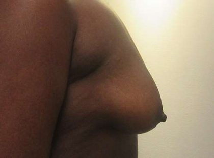 Breast Augmentation and Lift Before & After Patient #7184