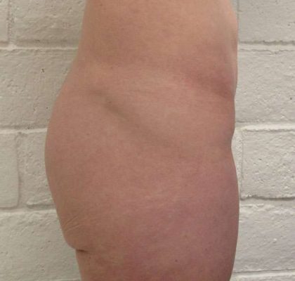 Body Lift Before & After Patient #5963