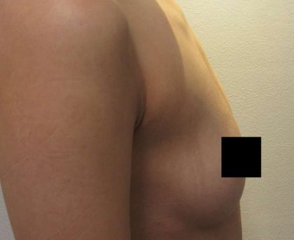 Breast Augmentation Implants Before & After Patient #7194