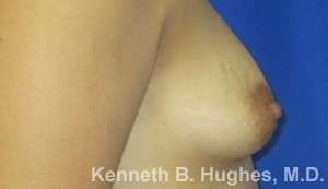 Breast Augmentation Implants Before & After Patient #7236
