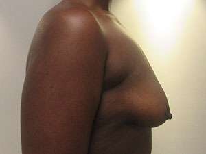 Breast Augmentation Implants Before & After Patient #7611