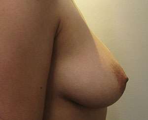 Breast Augmentation Implants Before & After Patient #7618
