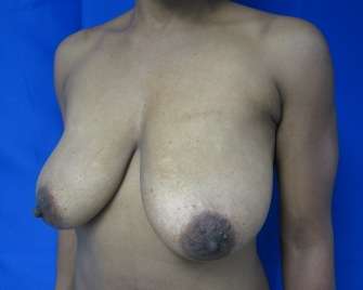 Breast Lift Before & After Patient #7927