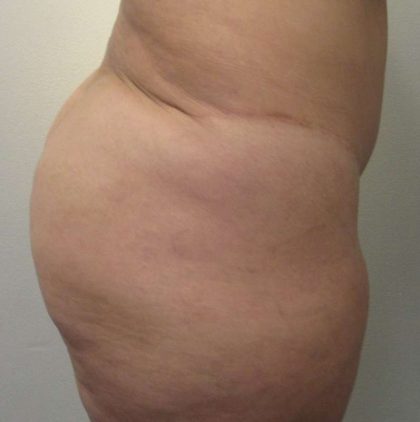 Body Lift Before & After Patient #5982