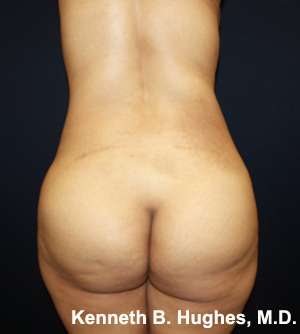 Butt Implants Before & After Patient #8134