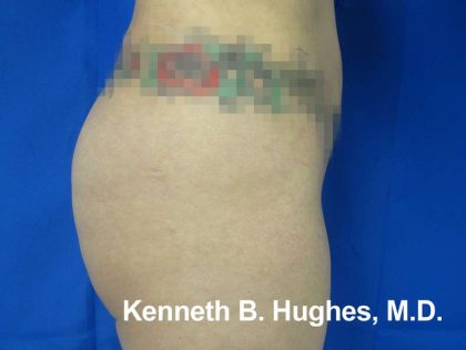 Butt Implants Before & After Patient #8147