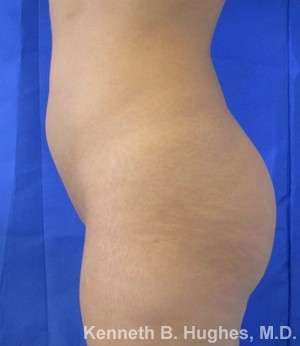 Butt Implants Before & After Patient #8173