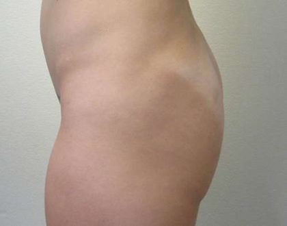 Butt Implants Before & After Patient #8198