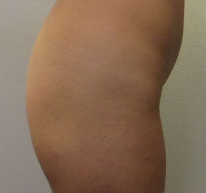 Butt Implants Before & After Patient #8214