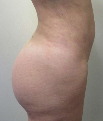 Butt Implants Before & After Patient #8219