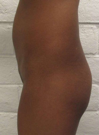 Butt Implants Before & After Patient #8241